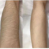 جدیدترین دستگاه لیزر 2025 در شهر جم|خدمات آرایشگری و زیبایی|جم, |دیوار