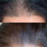 آموزش وارائه خدمات ژل و بوتاکس و فیلربادی(ژل بدن)|خدمات آرایشگری و زیبایی|جهرم, |دیوار