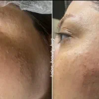 ژل وبوتاکس|خدمات آرایشگری و زیبایی|اهواز, پردیس دو|دیوار