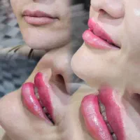 بوتاکس فول فیس فقط یک نفر