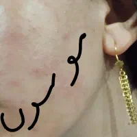 روشن کننده وضدلک درمانی بدون بازگشت تضمینی|آرایشی، بهداشتی، درمانی|یاسوج, |دیوار