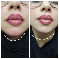 تزریقات تخصصی ژل و بوتاکس|خدمات آرایشگری و زیبایی|اهواز, شهرک دانشگاه|دیوار