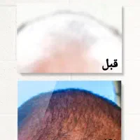 آیا علت ریزش مو را میدانید|آرایشی، بهداشتی، درمانی|جیرفت, |دیوار