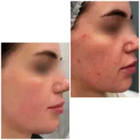 PRP توسط پزشک با تخفیف ویژه فقط تا ۳۱ تیر
