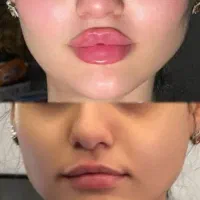 آف تزریق ژل وبوتاکس ومزومووصورت|خدمات آرایشگری و زیبایی|اهواز, نادری|دیوار