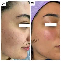 پاکسازی پوست در رشت ویژه عید نوروز ،فیشال تخصصی