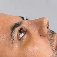 عمل بینی( راینو پلاستی)