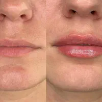 جشنواره تزریق فیلر مدت محدود فقط ۷۸۰ تومن|خدمات آرایشگری و زیبایی|زنجان, |دیوار