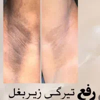 سفیدکردن‌نواحی تیره بدن|خدمات آرایشگری و زیبایی|ارومیه, |دیوار