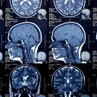 دریافت عکس MRI