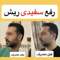 پک درمان رفع سفیدی مو ازریشه باضمانت ماندگاری۳ساله