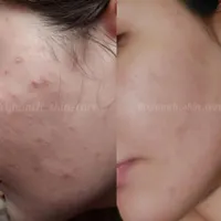 آموزش فیشیال،لاین پوست،اسکین کر