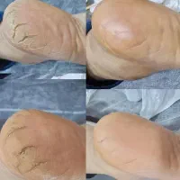 آموزش تخصصی پدیکوردرمانی،میخچه،مانیکور و اسپای دست