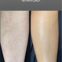 جشنواره تخفیف لیزر موهای زائد تضمینی تحت نظر پزشک|خدمات آرایشگری و زیبایی|خرم‌آباد, |دیوار