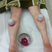 حجامت.زالودرمانی.فصد خون.بادکش|خدمات آرایشگری و زیبایی|سهند, |دیوار