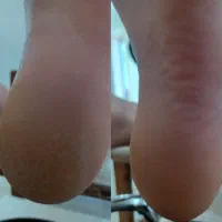 پدیکور درمانی و بادکش