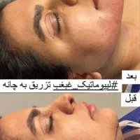 تزریق ژل بوتاکس ساکشن غبغب نخ لیفت توسط پزشک|خدمات آرایشگری و زیبایی|کرج, گلشهر|دیوار