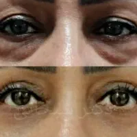 جراحی پلک بلفاروپلاستی لیفت ابرو شقیقه صورت پیشانی|خدمات آرایشگری و زیبایی|تهران, سلسبیل شمالی|دیوار