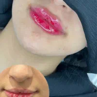 ژل و بوتاکس