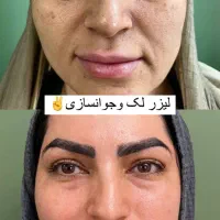 لیزرco2ترکیبی تک جلسه ای هموارساز اف ویژه