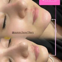 تزریق ژل بوتاکس فیلر با تخفیف|خدمات آرایشگری و زیبایی|گنبد کاووس, |دیوار