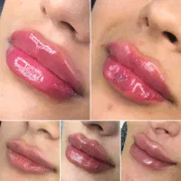 بوتاکس، فیلر و خدمات پیرسینگ