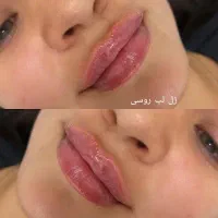 تخفیف ۵۰درصدی تزریق ژل چربی بوتاکس و جراحی زنان|خدمات آرایشگری و زیبایی|رشت, گلسار|دیوار