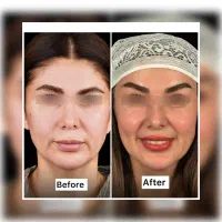 جراحی و زیبایی صورت و بدن،بلفارو،چربی، فیلر