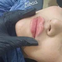 ژل و بوتاکس|خدمات آرایشگری و زیبایی|کرمانشاه, |دیوار