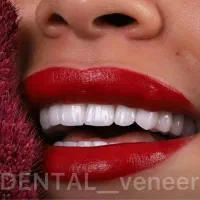 دندانپزشکی کامپوزیت ایمپلنت لمینت  (بدون تراش)|خدمات آرایشگری و زیبایی|تهران, زعفرانیه|دیوار