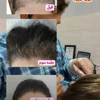 ۳۵۰،۰۰۰۰ت اعتبار  باشگاه یانا و مایا(مزوتراپی/PRP)|خدمات آرایشگری و زیبایی|شوش, |دیوار