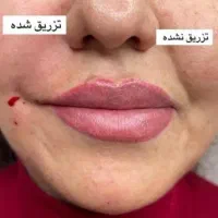 جشنواره زیبایی((مدل ژل وبوتاکس))|خدمات آرایشگری و زیبایی|سنندج, |دیوار