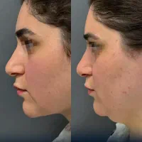 جشنواره تکرار نشدنی ساکشن غبغب و ..کلینیک پالادیوم