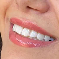 کامپوزیت لب شیشه ای اقساطی|خدمات آرایشگری و زیبایی|اصفهان, کوی ولی عصر|دیوار
