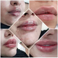 لیزر بوتاکس ژل خالبرداری|خدمات آرایشگری و زیبایی|سیرجان, |دیوار