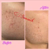 بوتاکس،ژل،چربی،ساکشن غبغب،آموزش سابسیژن پی ارپی|خدمات آرایشگری و زیبایی|اصفهان, شاهزید|دیوار