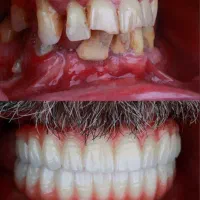 ایمپلنت با اقساط بلند مدت در تبریز|خدمات آرایشگری و زیبایی|اهر, |دیوار