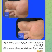 درمان ترک پا ومیخچه|آرایشی، بهداشتی، درمانی|تربت‌حیدریه, داروپخش|دیوار