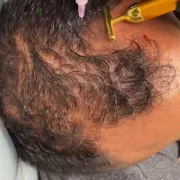 آموزش تخصصی مزوتراپی و پی‌آرپی سر و صورت