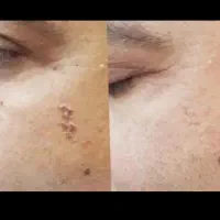 درمان و مدیریت HPV با مشاوره تخصصی