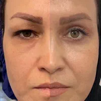 بلفاروپلاستی - ساکشن غبغب - بوکال فت - سانترال لب