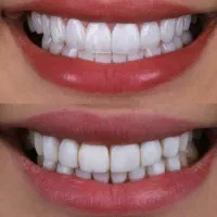 جشنواره کامپوزیت لمینیت روکش عصب ونیر بریدج ترمیم|خدمات آرایشگری و زیبایی|تهران, هفت حوض|دیوار