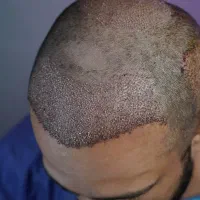 کاشت تخصصی مو به روش FIT|خدمات آرایشگری و زیبایی|رشت, گلسار|دیوار