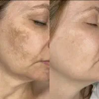 لیزرموزائدتیتانیوم ویژه روز مادر ۵۹۰تومن|خدمات آرایشگری و زیبایی|گرگان, |دیوار