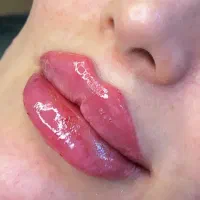 تزریق ژل وبوتاکس|خدمات آرایشگری و زیبایی|قم, بکایی|دیوار