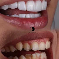 کامپوزیت دندان/لمینیت/دندانپزشکی