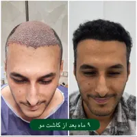 کاشت مو روش سوپر FUE پلاس(روش شیرازی)
