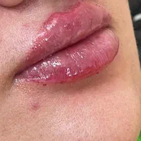 ژل و بوتاکس ‌‌پاکسازی|خدمات آرایشگری و زیبایی|مشهد, شهید معقول|دیوار