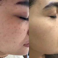 لیزر ، الکترولیز ، روشن سازی ، کک‌ و مک توسط پزشک|خدمات آرایشگری و زیبایی|بندرعباس, |دیوار