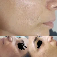 فستیوال رفع لک و تیرگی با لیزر کیوسوئیچ تضمینی
